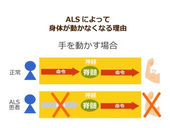 Alsが高齢者を中心に増加 治療法不明の病気が40年前と比べて29倍に ニッポンの介護学 みんなの介護