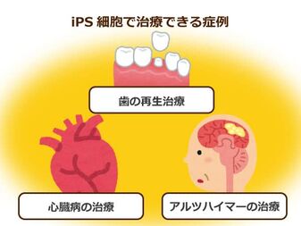 パーキンソン病のips細胞を使った治験が８月から開始 Ips細胞の活用が高齢者医療を劇的に変える ニッポンの介護学 みんなの介護